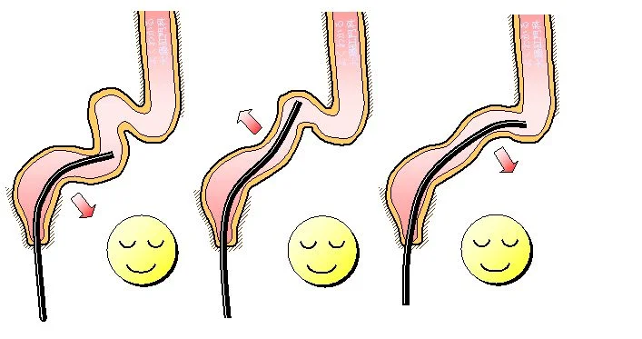 特徴５、無送気軸保持短縮法で行うため腸への負担を軽減できます