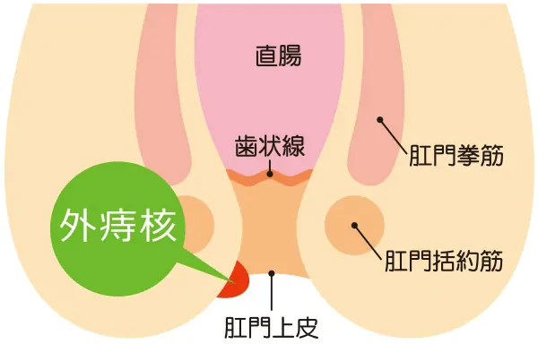 外痔核