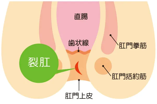 切れ痔（裂肛）