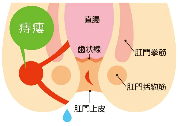 痔瘻（穴痔）