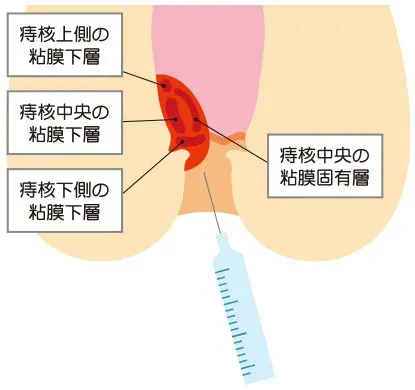 注射のみで痔核が消退！